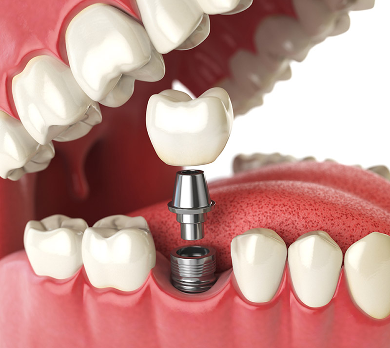 all on 4 dental implants in sidney