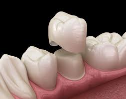 dental crowns near me sidney