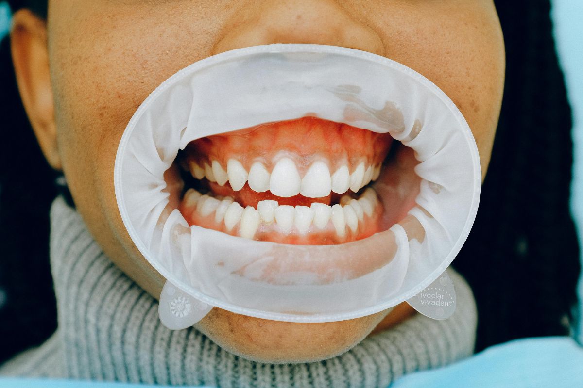 Home Remedies for Black Gums