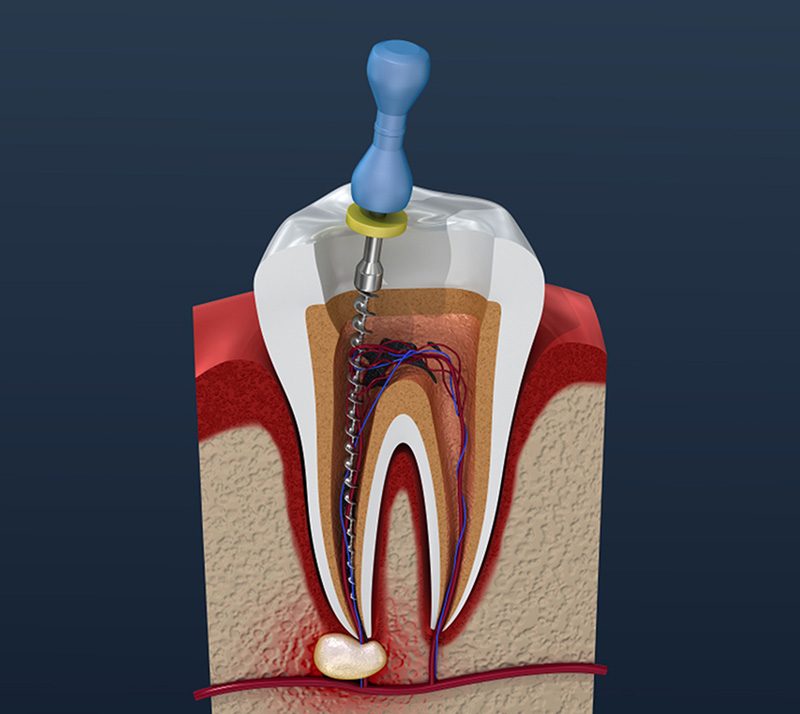 root canal therapy near you