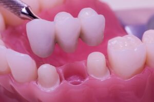 Types of Dental Bridges: Which One Is Right for You?