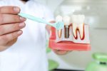 what-are-the-pros-and-cons-of-all-on-4-dental-implants