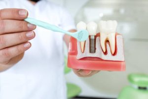 what-are-the-pros-and-cons-of-all-on-4-dental-implants