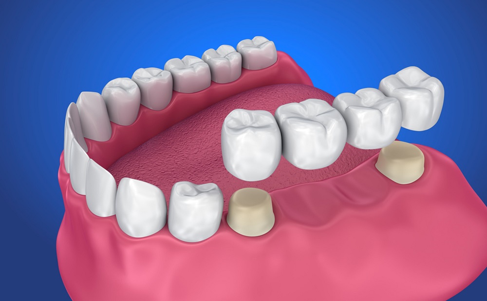 Your Guide to Dental Bridges